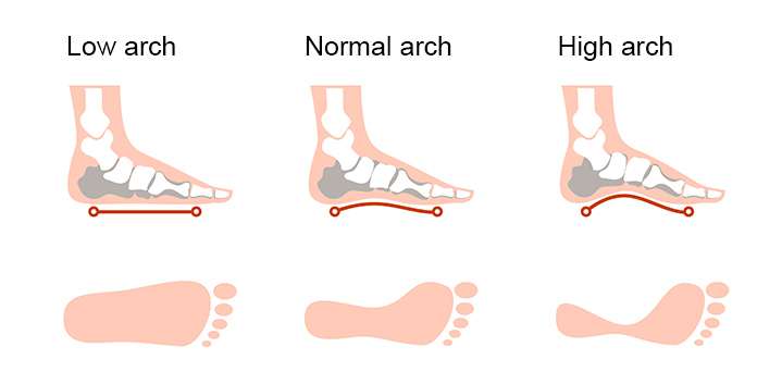A chart showing the three types of foot arches, normal arch, flat arch and high arch